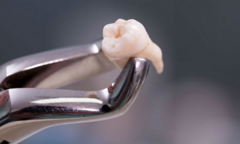 Рекомендации пациентам после операции удаления зуба